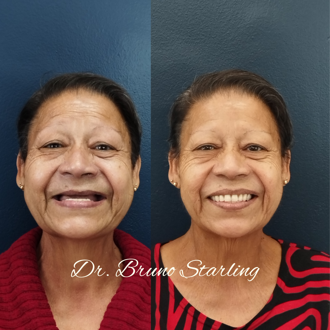 Resultado de Implante 2